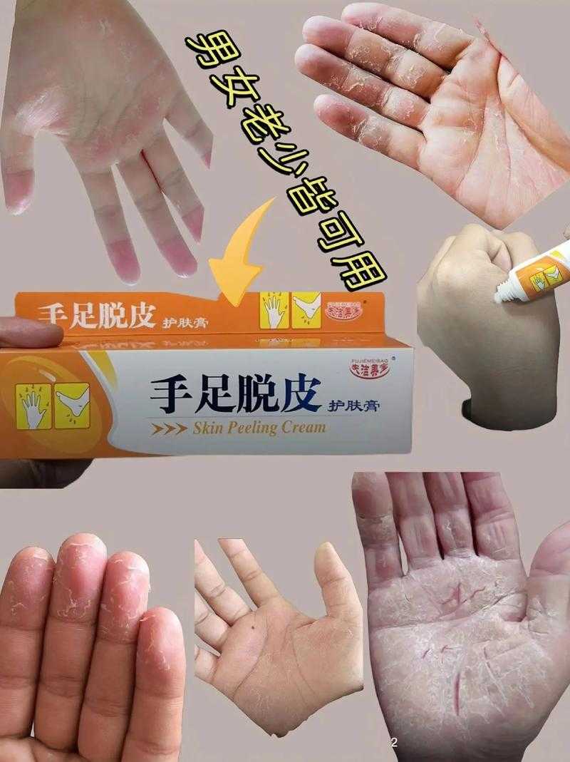 如何有效防治手足癣?有哪些实用方法?